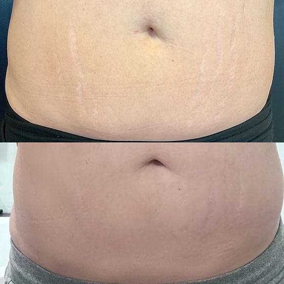Inkless Stretch Mark Revision at Moonlit Beauty and Ink in Lewisville, TX